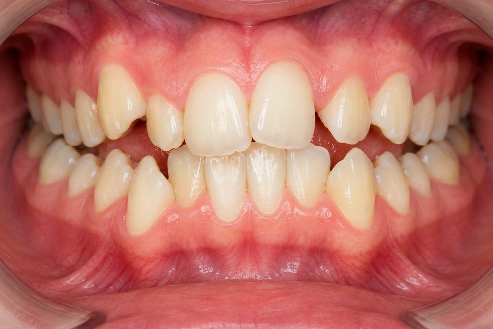 Illustration of crowded or overlapping teeth