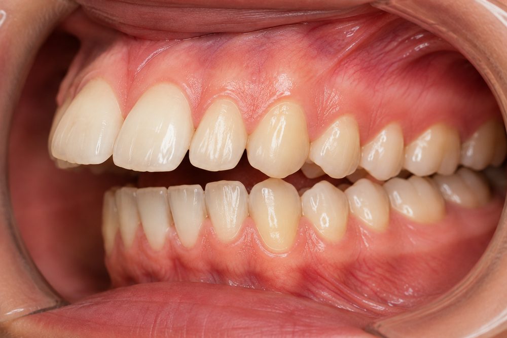 Illustration of protruding front teeth