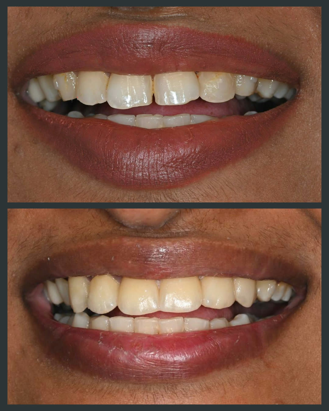 Before and after clear aligner treatment at Floss-it Dental Clinic