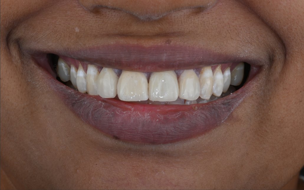 After Treatment