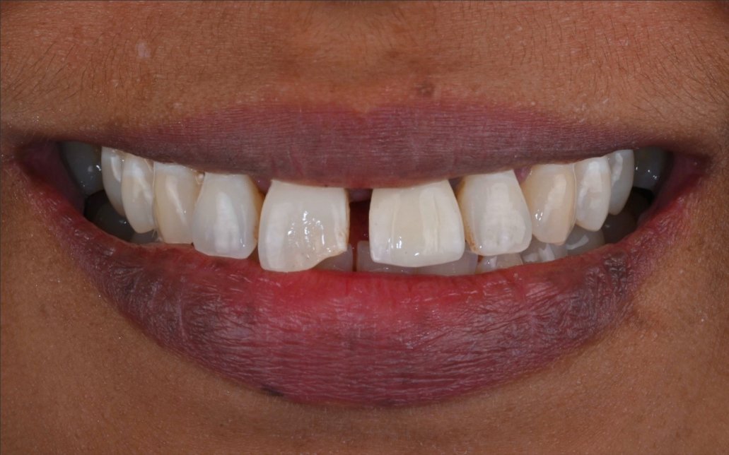 Before Treatment