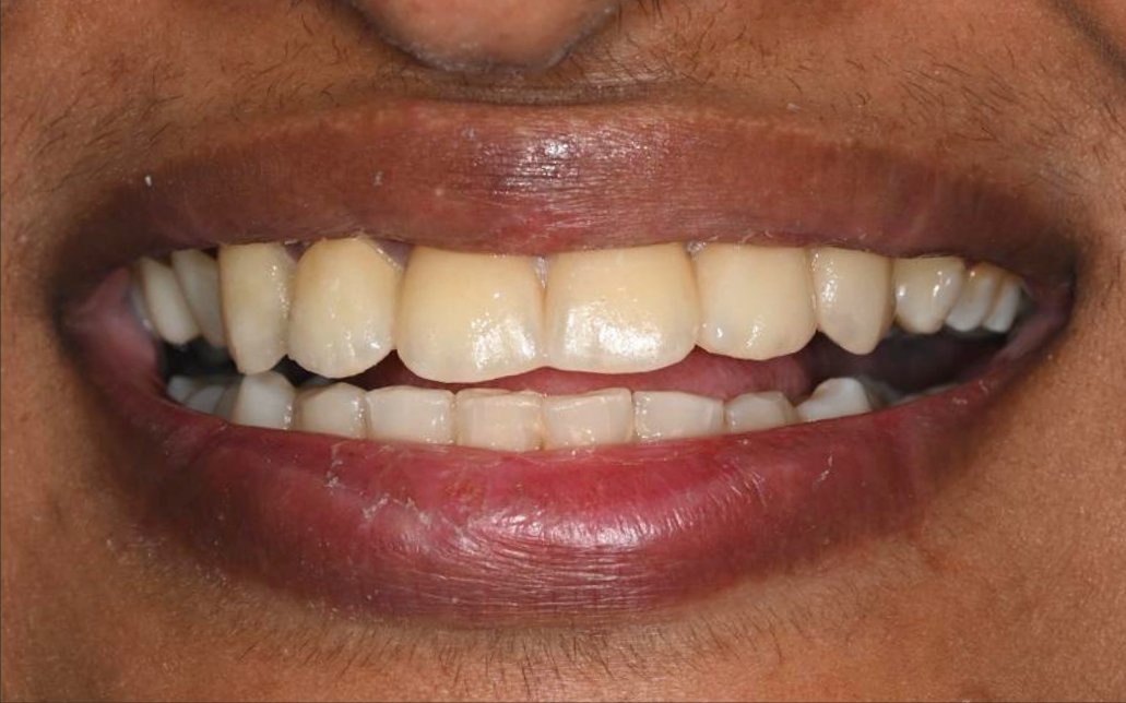 After Treatment