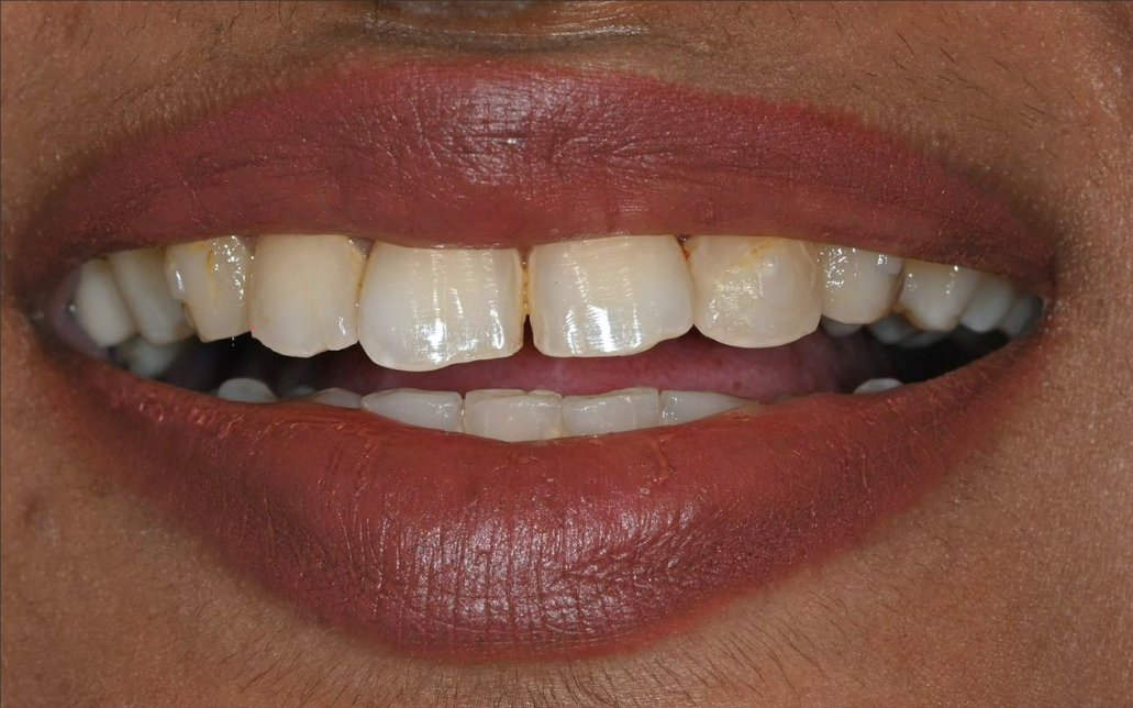 Before Treatment