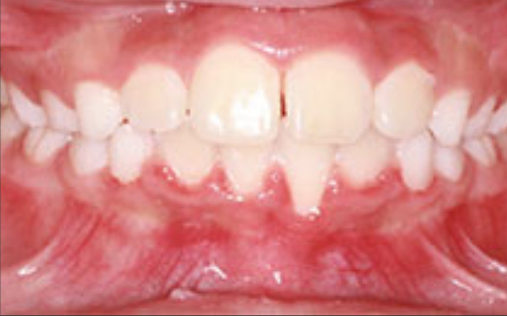 After Treatment