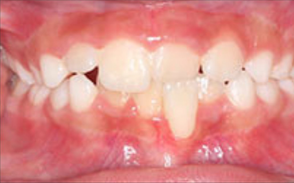 Before Treatment