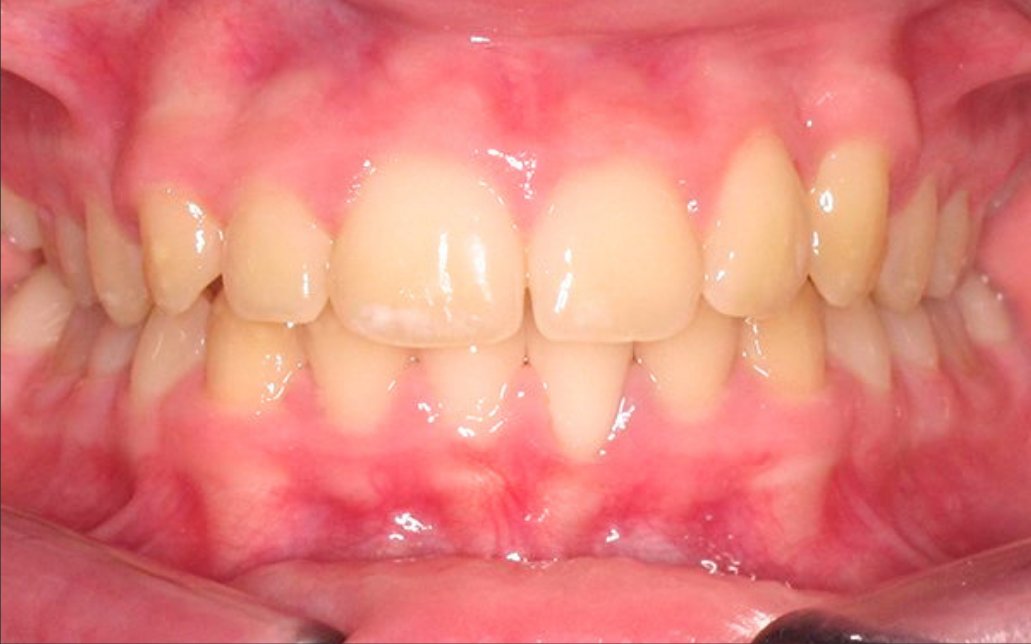 After Treatment