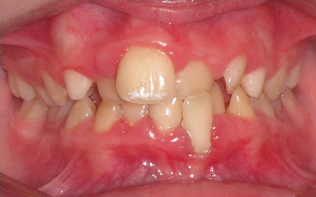 Before Treatment