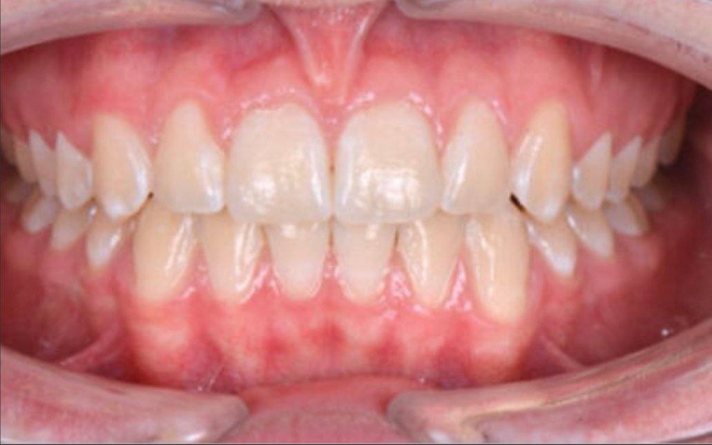 After Treatment
