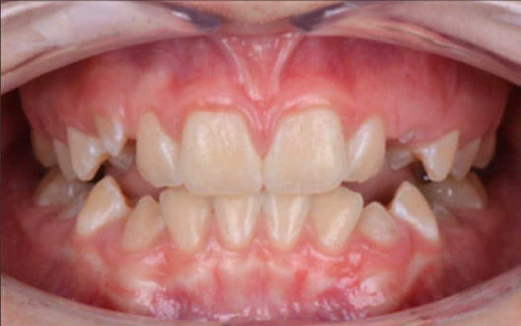 Before Treatment