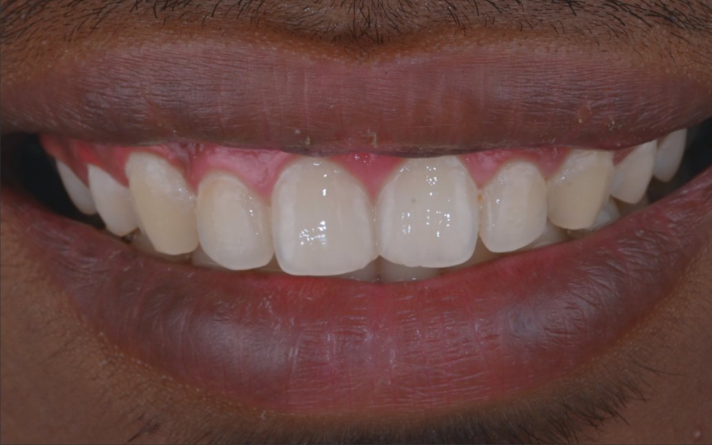 After Treatment