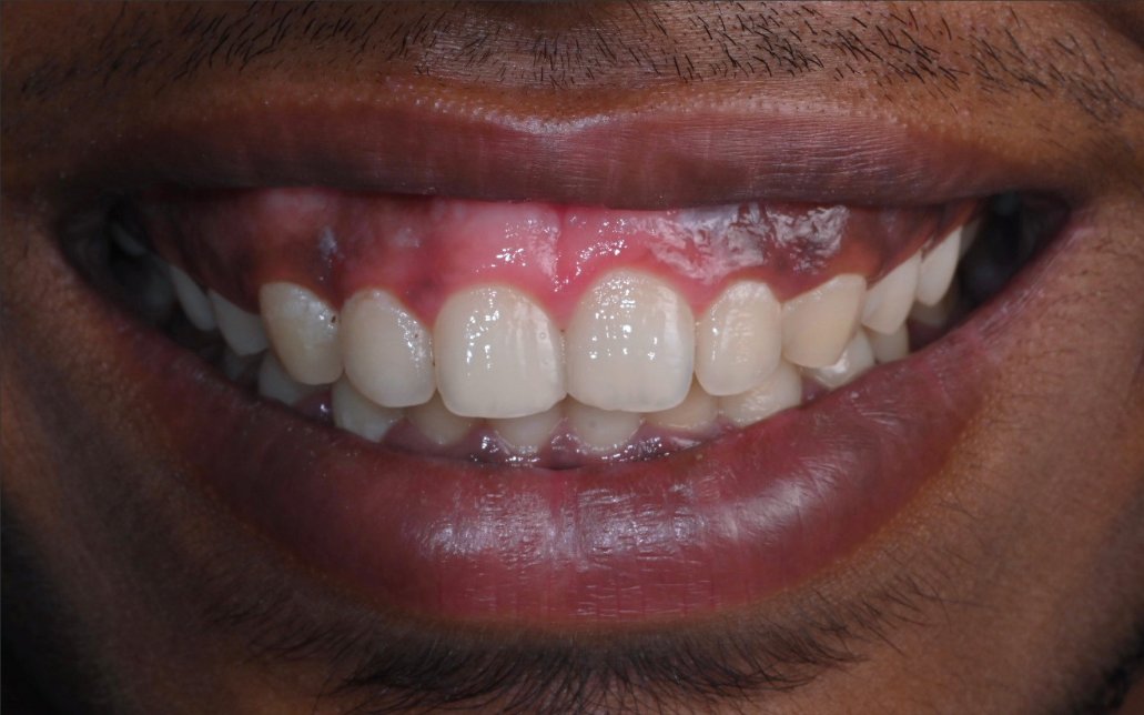 Before Treatment